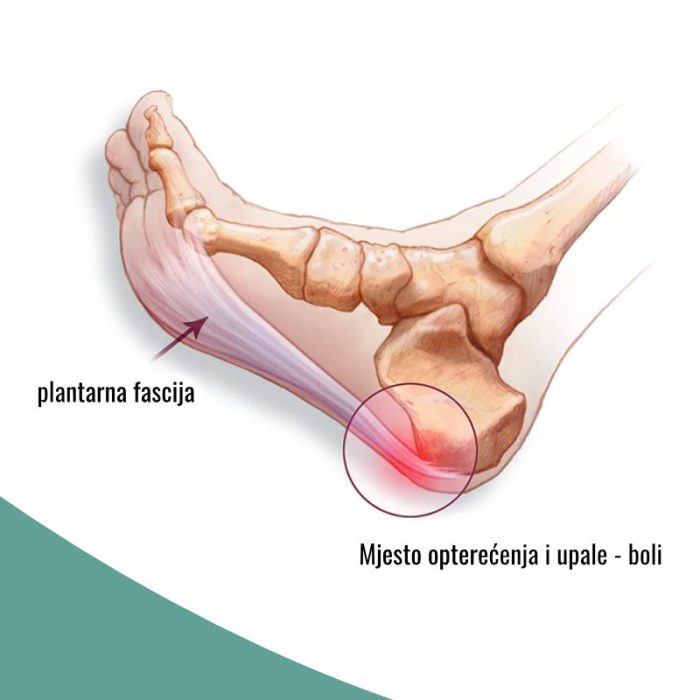 bol-u-peti-petni-trn Bol u peti