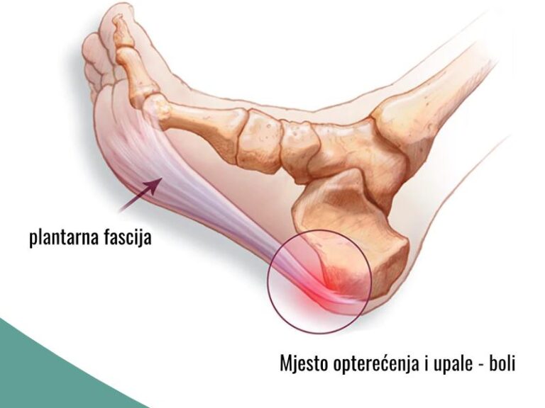 bol-u-peti-petni-trn Bol u peti