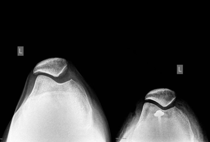 nestabilnost-patele-luksacija-patele nestabilnost patele