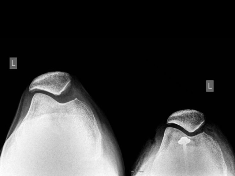 nestabilnost-patele-luksacija-patele nestabilnost patele