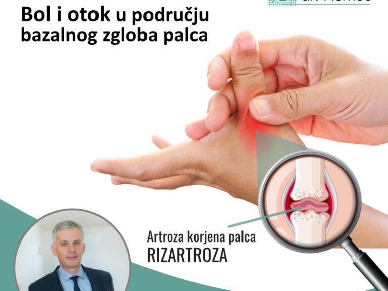 Bol u području bazalnog zgloba palca Rizartroza